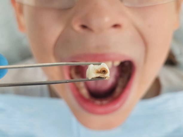 Best Emergency Root Canal Therapy in Brown City, MI